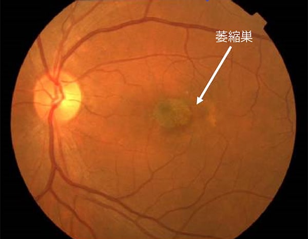  AMDと糖尿病の関係