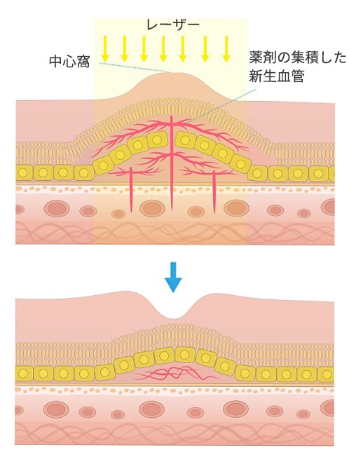 加齢黄斑変性画像6