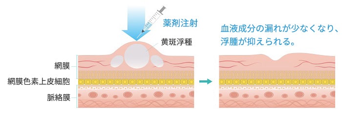 抗VEGF治療画像2