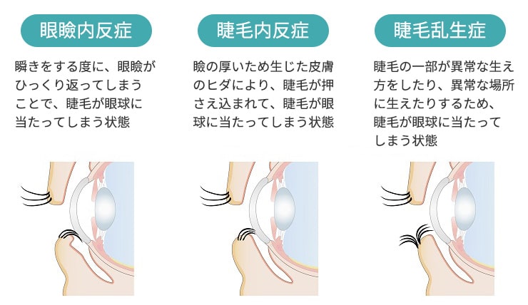 眼瞼下垂・逆さまつ毛画像1